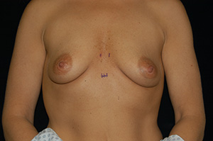 Breast Augmentation 4a
